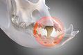 Tooth with visible plaque, tartar and calculus Royalty Free Stock Photo