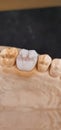 Tooth, wax up, molar , dental , hand made