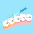 Tooth wear brace with brush Royalty Free Stock Photo