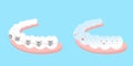 Tooth wear different brace