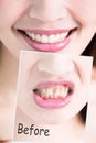 Tooth whiten concept