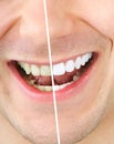 Tooth whitening