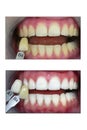 Tooth whitening , before and after