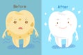 Tooth whitening before and after