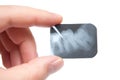 Tooth x-ray