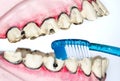 Toothbrush cleaning wooden dentures with caries and cavities on white background with copy space. Dental Health care