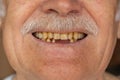 Toothless male smile mouth of senior elderly old man, dental problem, bad rotten teeth loss, caries Royalty Free Stock Photo