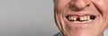 The toothless smile of an old European man on a gray background. Dentistry for pensioners, happy old age, dentist installing