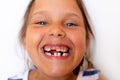 Toothless smiling, glad, mischievous girl show baby temporary milk teeth on white view. Crooked teeth, bad occlusion