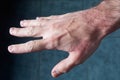 A top side view of extended male hand suffering dryness with cracked, wounded red skin. Young adult man with skin problem