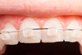 Top tooth alignment with ceramic braces Royalty Free Stock Photo