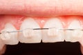 Top tooth alignment with ceramic braces