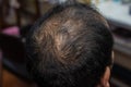Top view of Asian male pattern baldness.