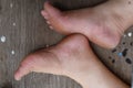 Top view, close-up, female feet, legs, cracked feet, dry skin, images for podiatrist medical concept.