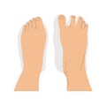 Top view comparison of healthy and deformed feet after wearing regular and barefoot shoes.