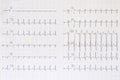 Top view of a complete electrocardiogram