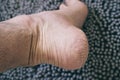 Top View of a Dry Cracked Heel on a Foot of a White Male
