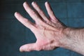 A top view of extended male hand suffering dryness with cracked, wounded red skin. Young adult man with skin problem