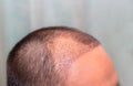 Top view of a man`s head with hair transplant surgery with a receding hair line