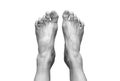 Top view picture of two bare human female feet with a wounded big toe healed with bandage for medical care. Black and white tone