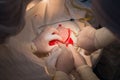 Top view, stages of neurosurgical surgery for installing a titanium plate in the patients skull. Pediatric neurosurgery.