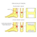 Torn Achilles tendon