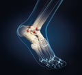Torn ligament in ankle, medically 3D illustration Royalty Free Stock Photo