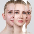Compare of old photo with acne and new healthy skin. Royalty Free Stock Photo