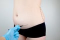 Abdominoplasty and torsoplasty: abdominal liposuction and removal of the apron. The patient at the reception at the plastic Royalty Free Stock Photo