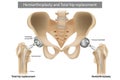 Total hip replacement components and Hemiarthroplasty. Implant Royalty Free Stock Photo