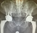 Total hips prosthesis xray image Royalty Free Stock Photo