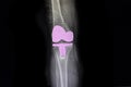 Total knee arthroplasty