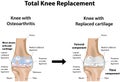 Total Knee Replacement Royalty Free Stock Photo
