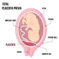 Total Placental previa. Dangerous Placenta Location During Pregnancy. Medical Pathology. detailed medical diagram with