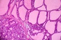 Toxic diffuse goiter, or Graves' disease, light micrograph