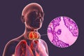 Toxic goiter, 3D illustration and micrograph