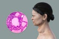 Toxic goiter, 3D illustration and micrograph