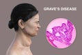 Toxic goiter, 3D illustration and micrograph