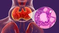 Toxic goiter, 3D illustration and micrograph Royalty Free Stock Photo