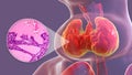 Toxic goiter, 3D illustration and micrograph Royalty Free Stock Photo