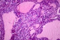 Toxic goiter, light micrograph Royalty Free Stock Photo