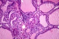 Toxic goiter, light micrograph Royalty Free Stock Photo