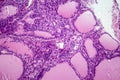 Toxic goiter, light micrograph Royalty Free Stock Photo