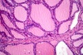 Toxic goiter, light micrograph