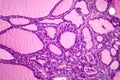 Toxic goiter, light micrograph Royalty Free Stock Photo