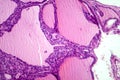 Toxic goiter, light micrograph Royalty Free Stock Photo