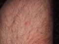 Traces of bites of blood-sucking insects (mosquitoes, horseflies) on human skin