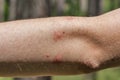 Traces of mosquito bites on the human elbow