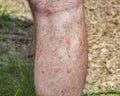 Traces of mosquito bites on the human leg