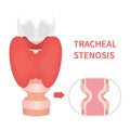 Trachea narrowing awareness icon of tracheal stenosis